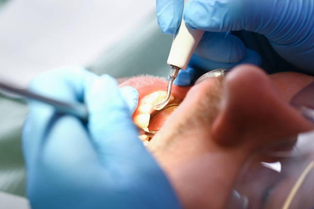Best Dental Abscess Treatment in Maplewood, WA